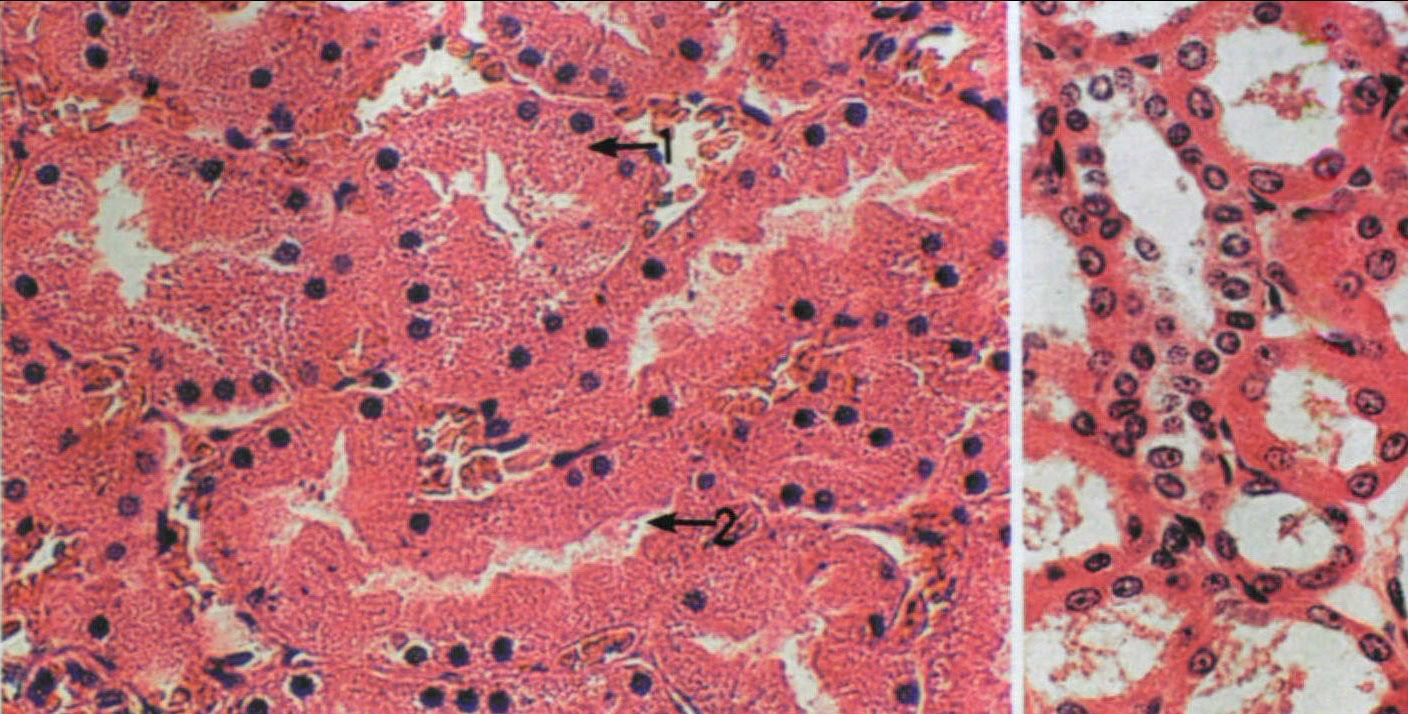 图1 肾小管上皮细胞肿胀